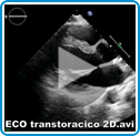 Ecocardiograma transtorácico