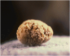 1 Imagen litiasis Cálculo