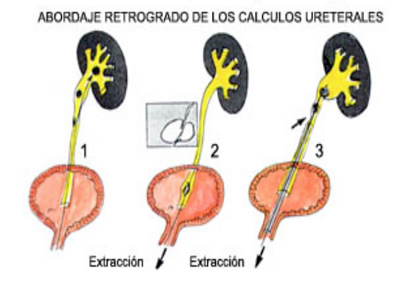 Abordaje cálculos