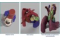 Varios ejemplos de modelos cardiacos personalizados realizados en la Unidad de Planificación Quirúrgica 3D