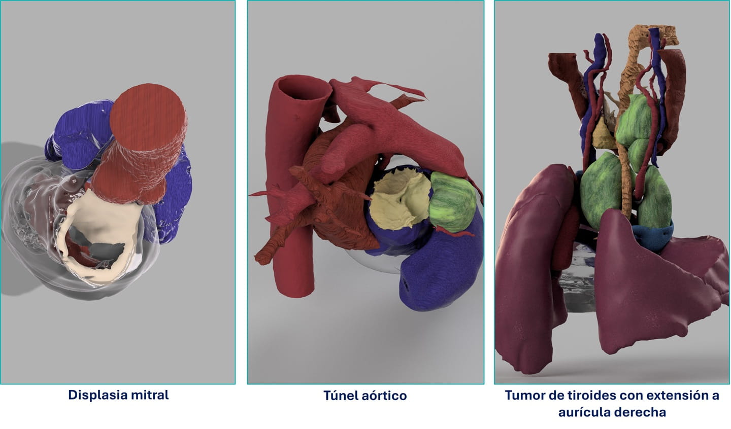 Varios ejemplos de modelos cardiacos personalizados realizados en la Unidad de Planificación Quirúrgica 3D