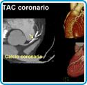 TAC Coronario