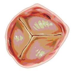 Implante percutaneo 1