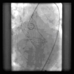 Implante percutaneo 32
