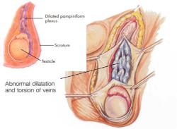varicocele