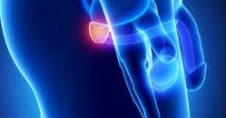 hiperplasia-prostatica