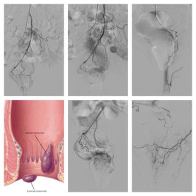 Tratamiento de las hemorroides sin dolor