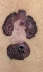 lunares_con_melanoma
