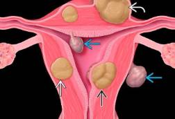 tratamiento-miomas-uterinos