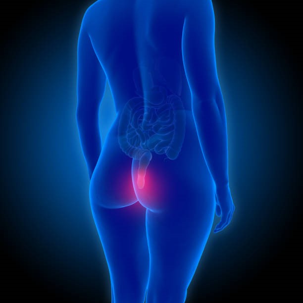 Tratamiento hemorroides