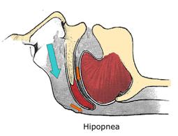 hipopnea