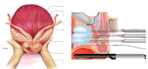 Crioterapia