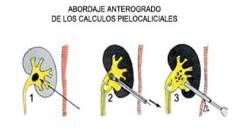 Abordaje cálculos