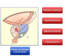 Cáncer de próstata