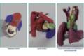 Varios ejemplos de modelos cardiacos personalizados realizados en la Unidad de Planificación Quirúrgica 3D